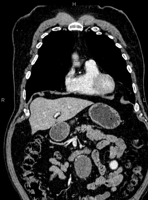 Abdominal aortic aneurysm (Radiopaedia 83094-97462 Coronal renal cortical phase 33).jpg