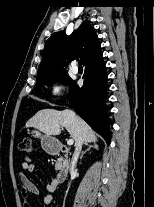 Abdominal aortic aneurysm (Radiopaedia 83094-97462 Sagittal renal cortical phase 52).jpg