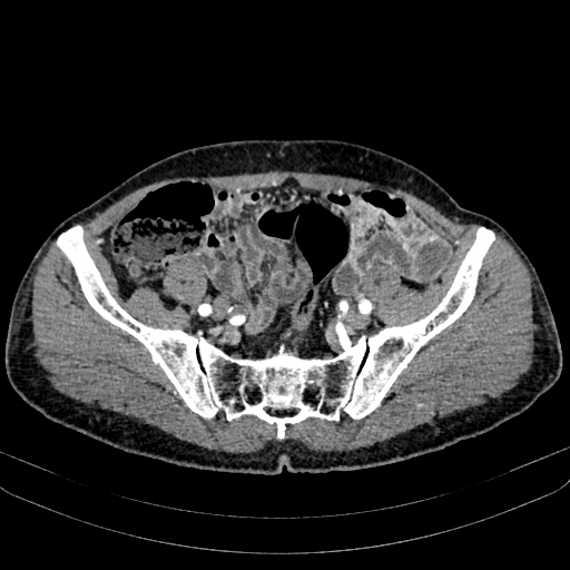 Abdominal aortic aneurysm (Radiopaedia 83581-98689 Axial C+ arterial phase 91).jpg