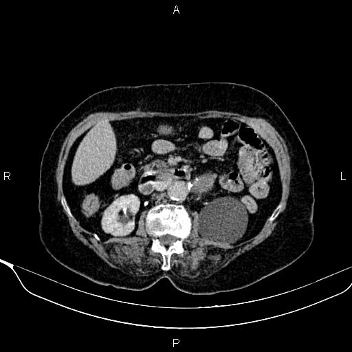 Abdominal aortic aneurysm (Radiopaedia 85063-100606 Axial C+ delayed 45).jpg