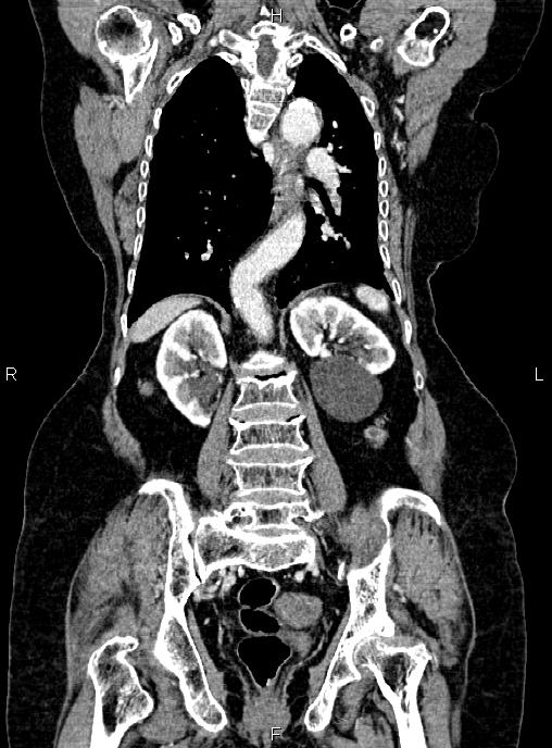 Abdominal aortic aneurysm (Radiopaedia 85063-100606 Coronal C+ arterial phase 39).jpg