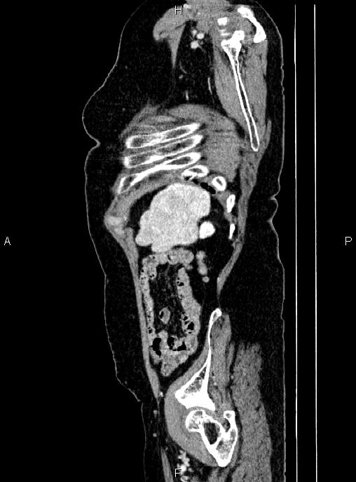 Abdominal aortic aneurysm (Radiopaedia 85063-100606 Sagittal C+ arterial phase 72).jpg