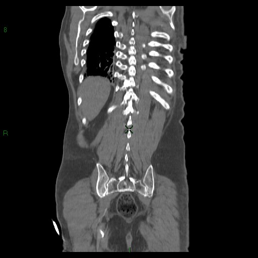File:Abdominal aortic aneurysm rupture with aortocaval fistula (Radiopaedia 14897-14841 Coronal C+ arterial phase 36).jpg