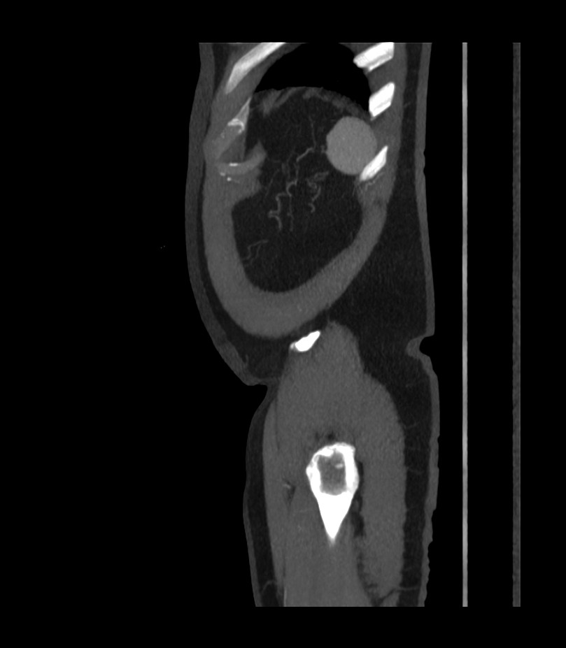 Abdominal aortic aneurysm with thrombus fissuration (Radiopaedia 46218-50618 Sagittal C+ arterial phase 55).jpg