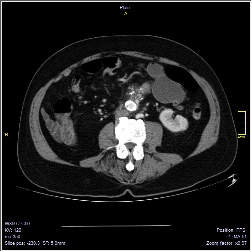 Abdominal aortic aneurysm with thrombus fissuration (Radiopaedia 47340-51926 Axial C+ arterial phase 35).jpg