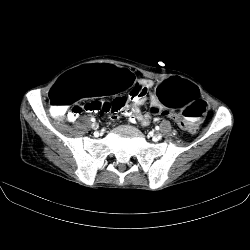 File:Abdominal collection due to previous cecal perforation (Radiopaedia 80831-94320 Axial C+ portal venous phase 152).jpg