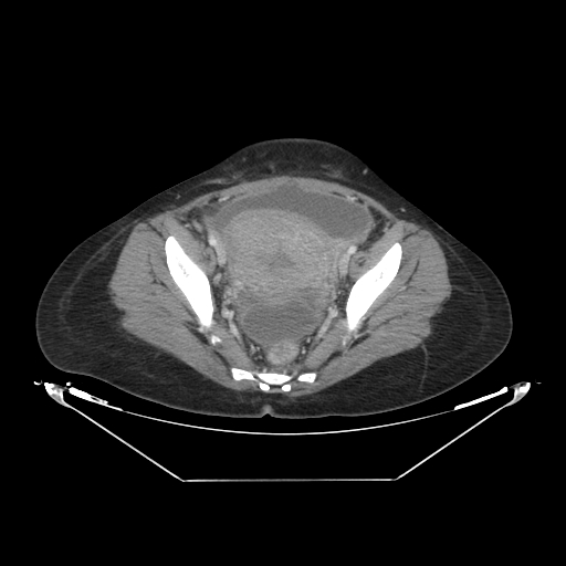 File:Abdominal gossypiboma- surgical towel (Radiopaedia 57288-64226 Axial C+ portal venous phase 65).jpg
