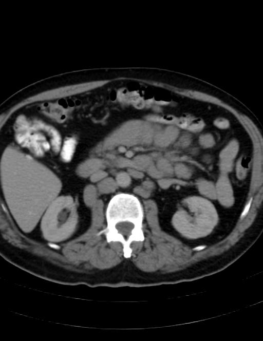 Abdominal lymphoma - with sandwich sign (Radiopaedia 53486-59492 Axial C+ portal venous phase 22).jpg
