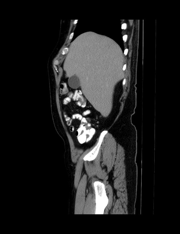Abdominal lymphoma - with sandwich sign (Radiopaedia 53486-59492 Sagittal C+ portal venous phase 66).jpg