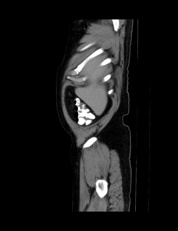 Abdominal lymphoma - with sandwich sign (Radiopaedia 53486-59492 Sagittal C+ portal venous phase 74).jpg