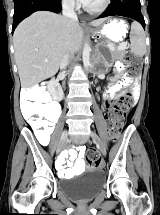 Abdominal wall and retroperitoneal tuberculosis (Radiopaedia 88137-104729 Coronal C+ portal venous phase 54).jpg