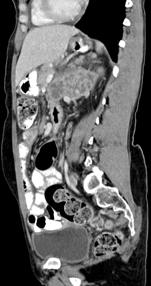 Abdominal wall and retroperitoneal tuberculosis (Radiopaedia 88137-104729 Sagittal C+ portal venous phase 63).jpg