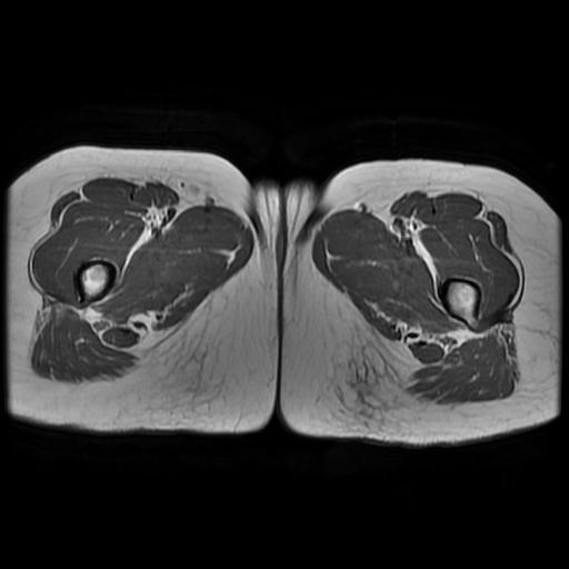 File:Abdominal wall endometriosis (Radiopaedia 83702-98847 Axial T1 24).jpg