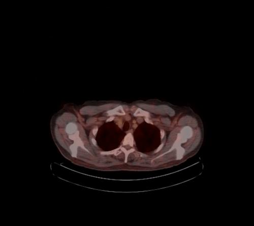 Abdominal wall metastasis from colorectal carcinoma (Radiopaedia 31016-31719 C 123).jpg