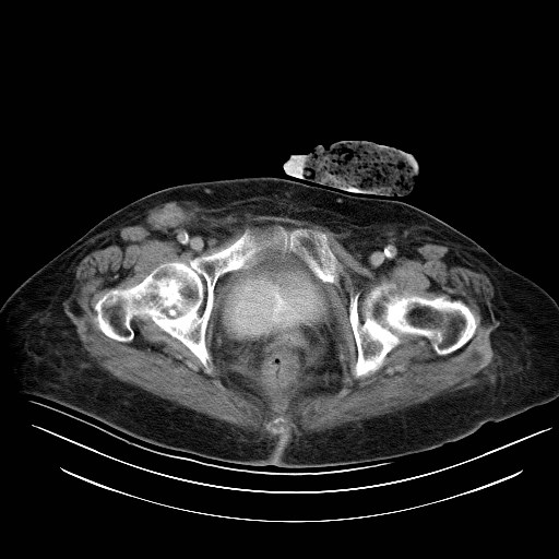 File:Abdominal wall recurrence after colorectal resection for cancer (Radiopaedia 23444-23523 Axial C+ portal venous phase 39).jpg