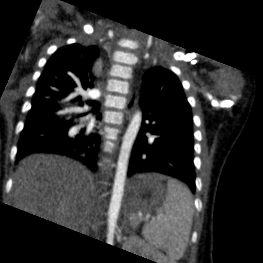 File:Aberrant left pulmonary artery (pulmonary sling) (Radiopaedia 42323-45435 Coronal C+ CTPA 10).jpg