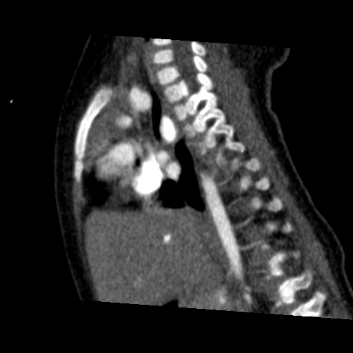 File:Aberrant left pulmonary artery (pulmonary sling) (Radiopaedia 42323-45435 Sagittal C+ arterial phase 31).jpg