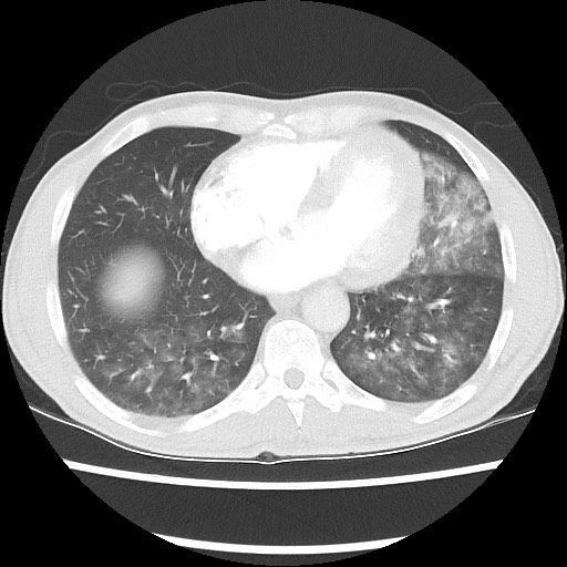 Accessory left horizontal fissure with lingular pneumonia (Radiopaedia 53763-59843 Axial lung window 39).jpg