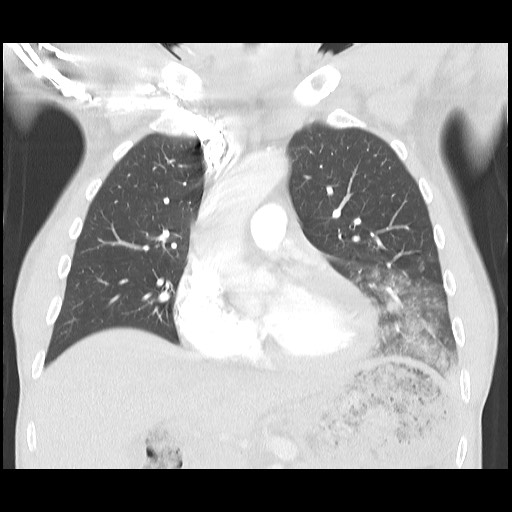 Accessory left horizontal fissure with lingular pneumonia (Radiopaedia 53763-59843 Coronal lung window 19).jpg