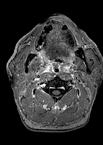 Accessory middle cerebral artery (Radiopaedia 73114-83828 Axial T1 C+ 256).jpg