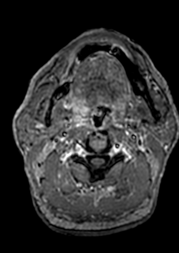 Accessory middle cerebral artery (Radiopaedia 73114-83828 Axial T1 C+ 276).jpg
