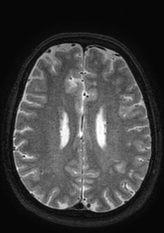 Accessory middle cerebral artery (Radiopaedia 73114-83828 Axial T2 14).jpg