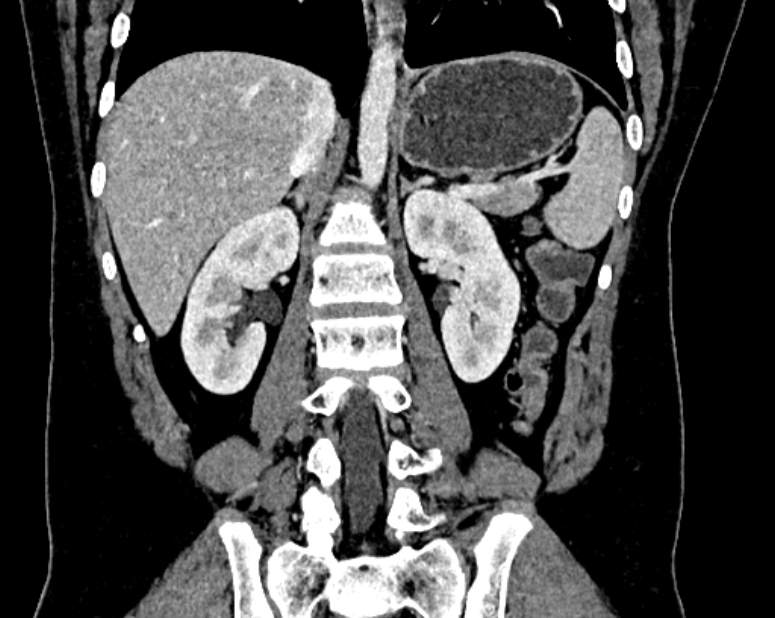 Accessory right inferior hepatic vein (Radiopaedia 75207-86305 Coronal C+ portal venous phase 44).jpg