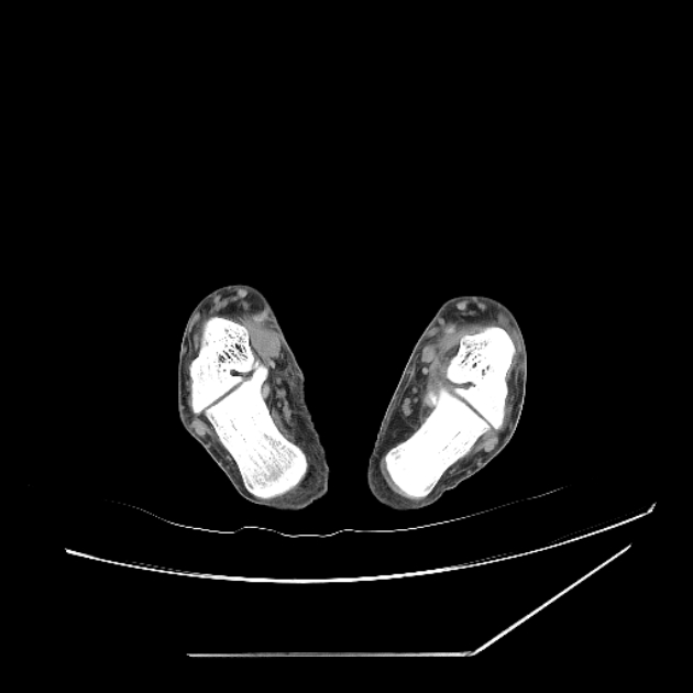 Accessory soleus muscle (Radiopaedia 61069-68943 Axial non-contrast 58).jpg