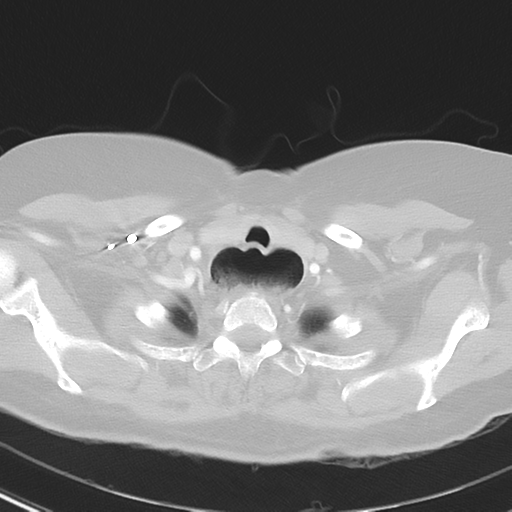 File:Achalasia (Radiopaedia 47147-51685 Axial lung window 5).png