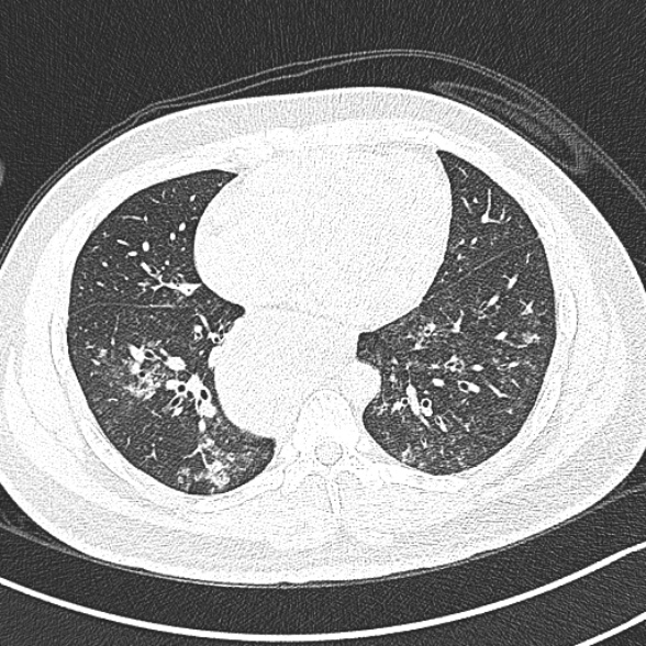 Achalasia with aspiration (Radiopaedia 55413-61845 Axial lung window 49).jpg