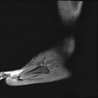 File:Achilles tendon tear (Radiopaedia 77615-89819 Sagittal PD fat sat 23).jpg