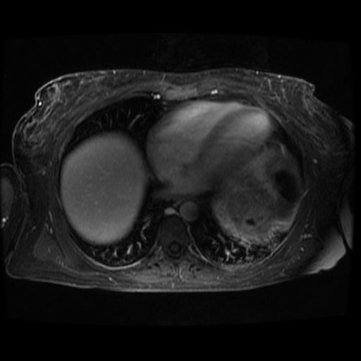 Acinar cell carcinoma of the pancreas (Radiopaedia 75442-86668 D 137).jpg