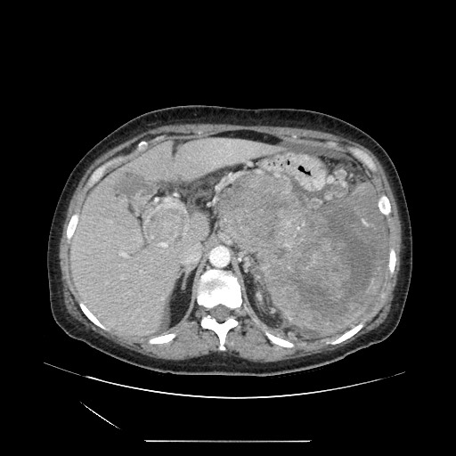 Acinar cell carcinoma of the pancreas (Radiopaedia 75442-86669 Axial C+ portal venous phase 38).jpg