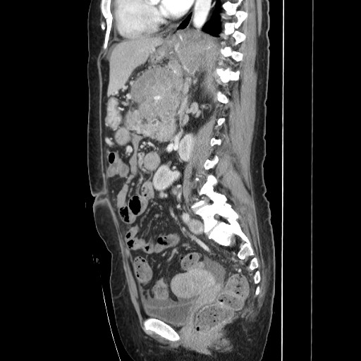 Acinar cell carcinoma of the pancreas (Radiopaedia 75442-86669 Sagittal C+ portal venous phase 109).jpg
