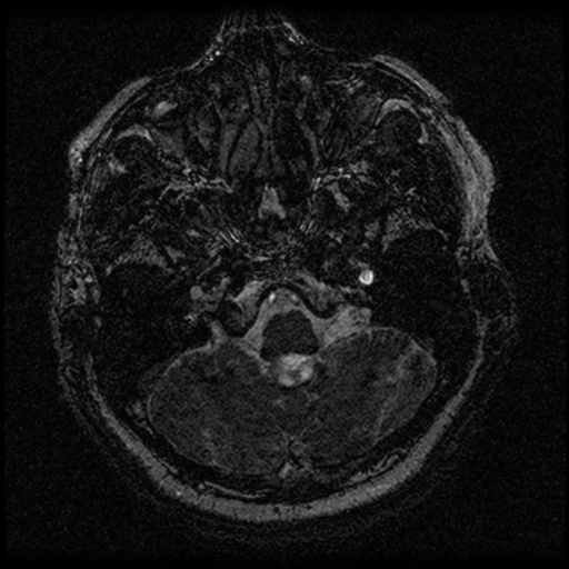 File:Acoustic schwannoma (Radiopaedia 33045-34060 Axial T2 4).png