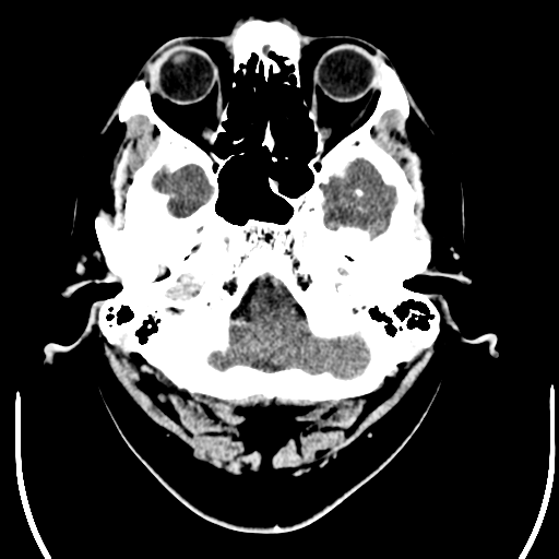 File:Acoustic schwannoma (Radiopaedia 39170-41389 Axial C+ 3).png