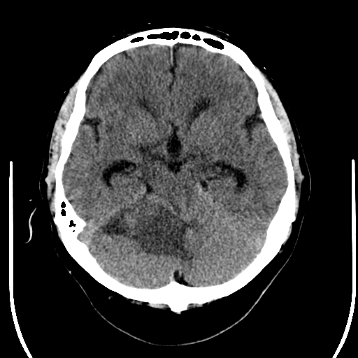 File:Acoustic schwannoma (Radiopaedia 39170-41389 Axial non-contrast 10).png