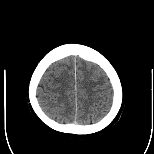 File:Acoustic schwannoma (Radiopaedia 39170-41389 Axial non-contrast 24).png