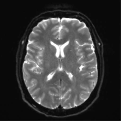 Acoustic schwannoma (Radiopaedia 50846-56358 Axial DWI 17).png
