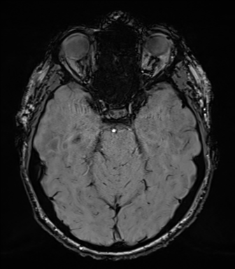 File:Acoustic schwannoma (Radiopaedia 50846-56358 Axial SWI 33).png
