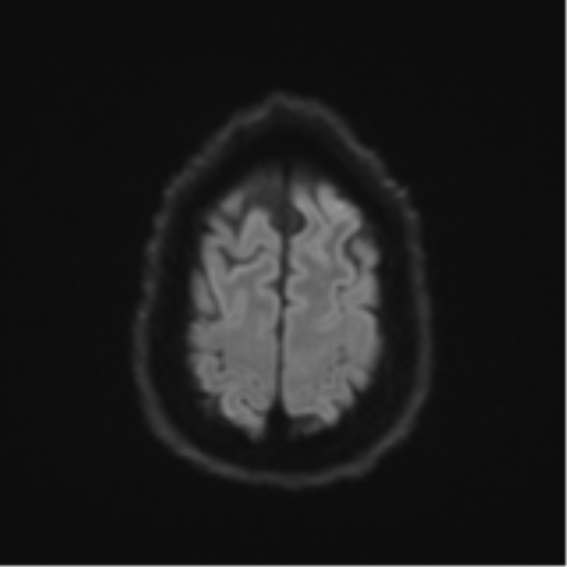 Acoustic schwannoma (Radiopaedia 55729-62281 E 52).png