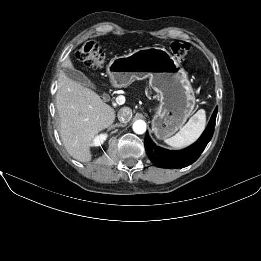 File:Acquired adrenal hyperplasia - due to thymic carcinoid tumor (Radiopaedia 21269-21184 C+ arterial phase 24).jpg