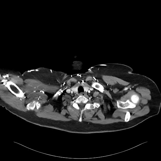 Acromioclavicular joint cyst (Radiopaedia 58455-65610 Axial C+ arterial phase 17).jpg