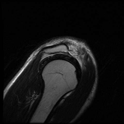File:Acromioclavicular joint dislocation (Radiopaedia 14218-14076 Sagittal T2 3).jpg