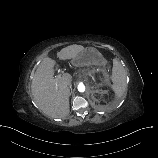 Active renal extravasation with large subcapsular and retroperitoneal hemorrhage (Radiopaedia 60975-68796 Axial C+ arterial phase 51).jpg