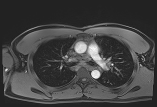 Active right ventricular cardiac sarcoidosis (Radiopaedia 55596-62100 Axial Post contrast Dixon 23).jpg