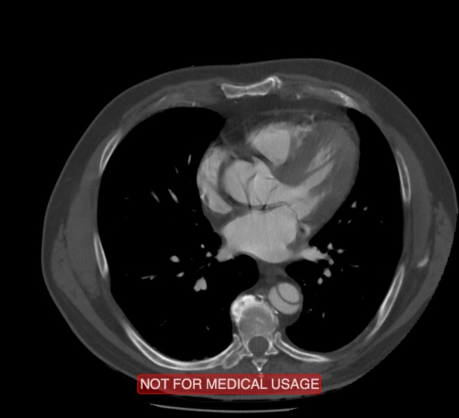 Acute aortic dissection - Stanford type A (Radiopaedia 40661-43285 Axial C+ arterial phase 40).jpg