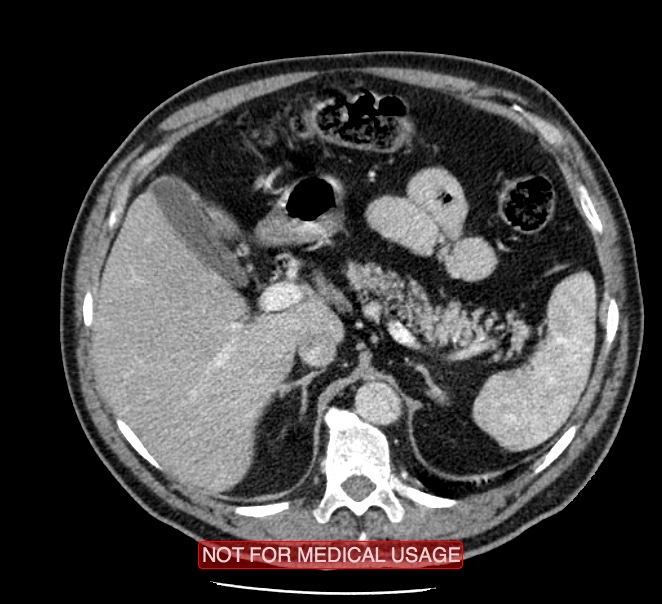 Acute aortic dissection - Stanford type A (Radiopaedia 40661-43285 Axial C+ portal venous phase 75).jpg