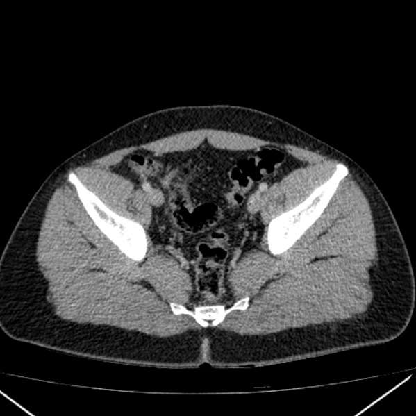 Acute appendicitis (Radiopaedia 38255-40270 Axial C+ portal venous phase 94).jpg