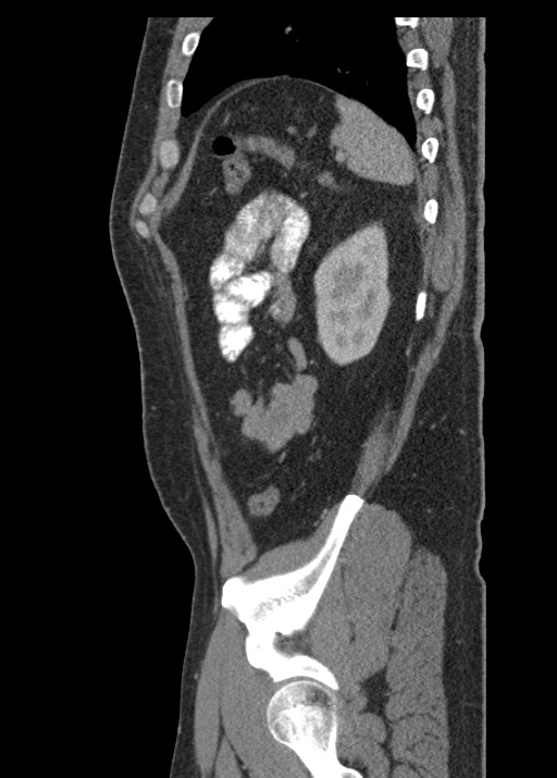 Acute appendicitis (Radiopaedia 48511-53463 Sagittal C+ portal venous phase 105).jpg